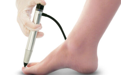 Fungal Toe Nails