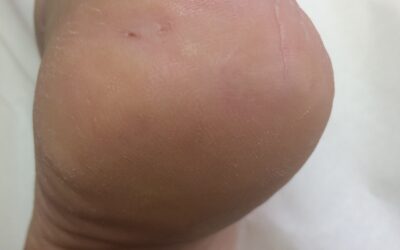 Treating Cracked Heels