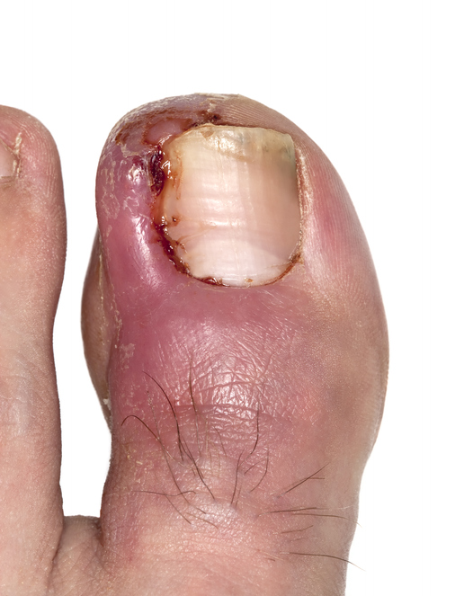 Ingrowing toenail